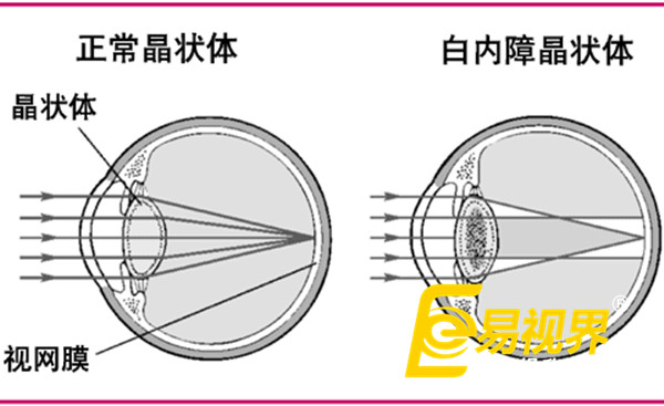  春節(jié)過(guò)量飲酒最傷眼  易視界