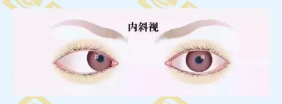 什么是調節(jié)性內斜視？