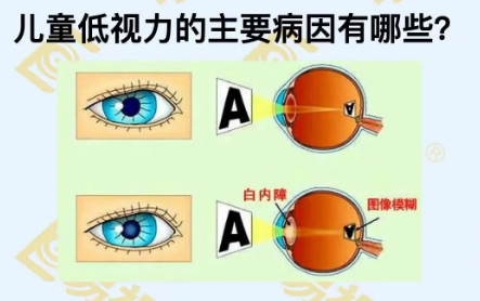 兒童低視力主要病因有哪些？