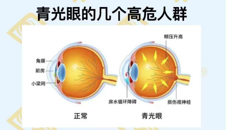 青光眼的幾個(gè)高危人群？