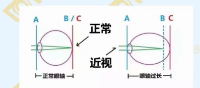 哪個年齡近視度數(shù)最容易增長？