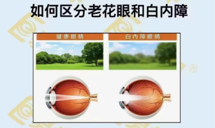 如何區(qū)分老花眼和白內(nèi)障？