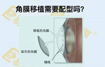 角膜移植需要配型嗎？