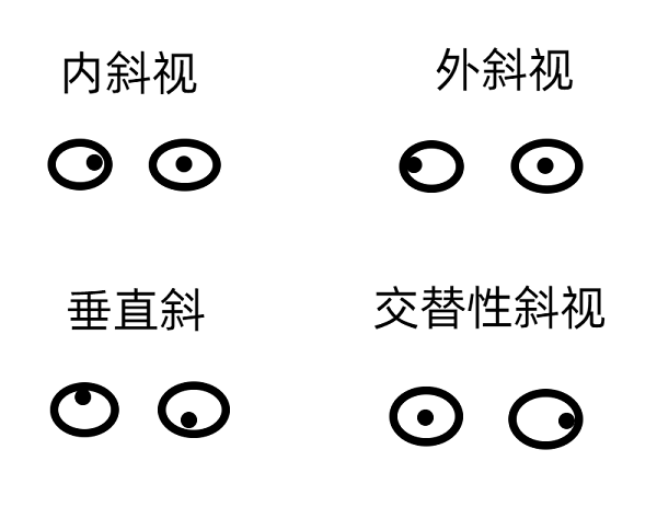 斜視早期的癥狀有哪些？